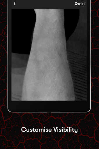 X-Vein