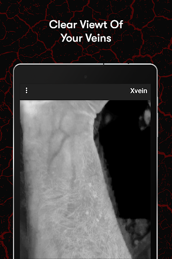 X-Vein