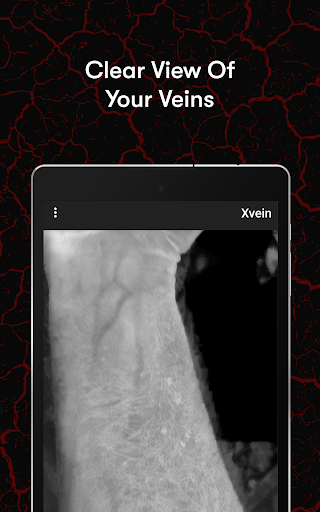 X-Vein