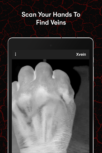 X-Vein